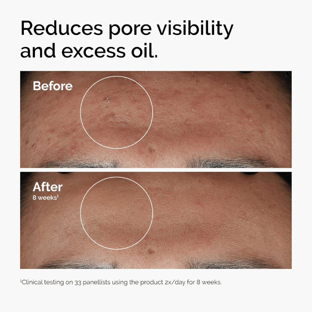 The Ordinary Niacinamide 10% & Zinc 1%