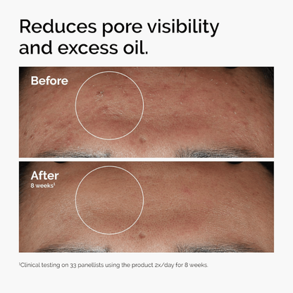 The Ordinary Niacinamide 10% & Zinc 1%