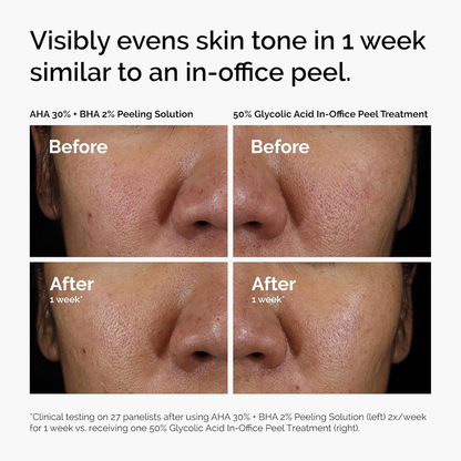 The Ordinary AHA 30% + BHA 2% Peeling Solution 30ml